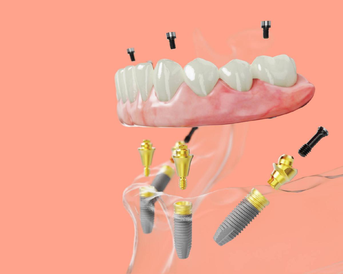 All on 4 implants