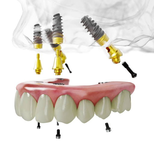 All-on-4® dental implants-supported dentures from the top prosthodontist in Duxbury, MA
