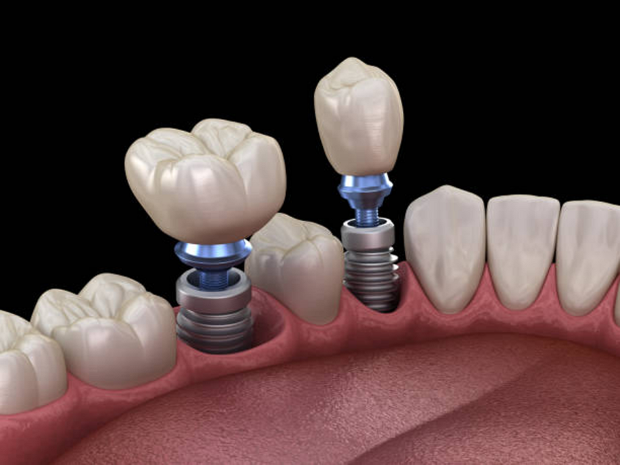 X-Guide® Machine for Dental Implant Surgery in Duxbury near Hangam, Cape Cod, and South Boston