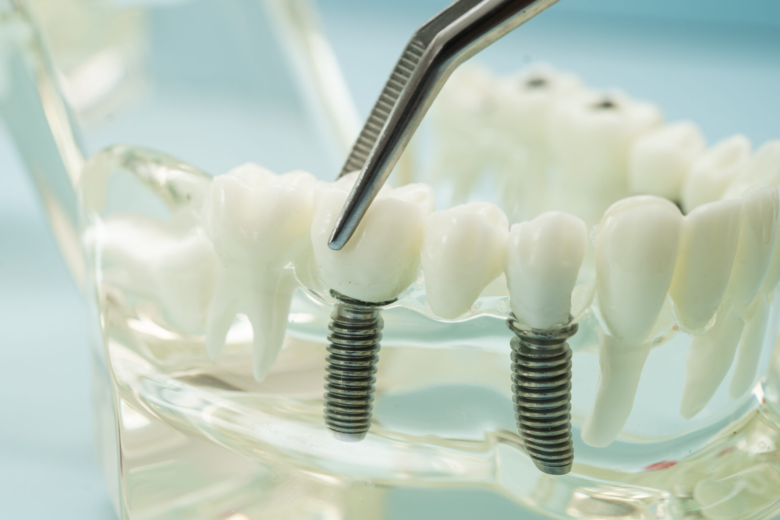 Dental implant dentist duxbury showing dental implant crowns on tooth model