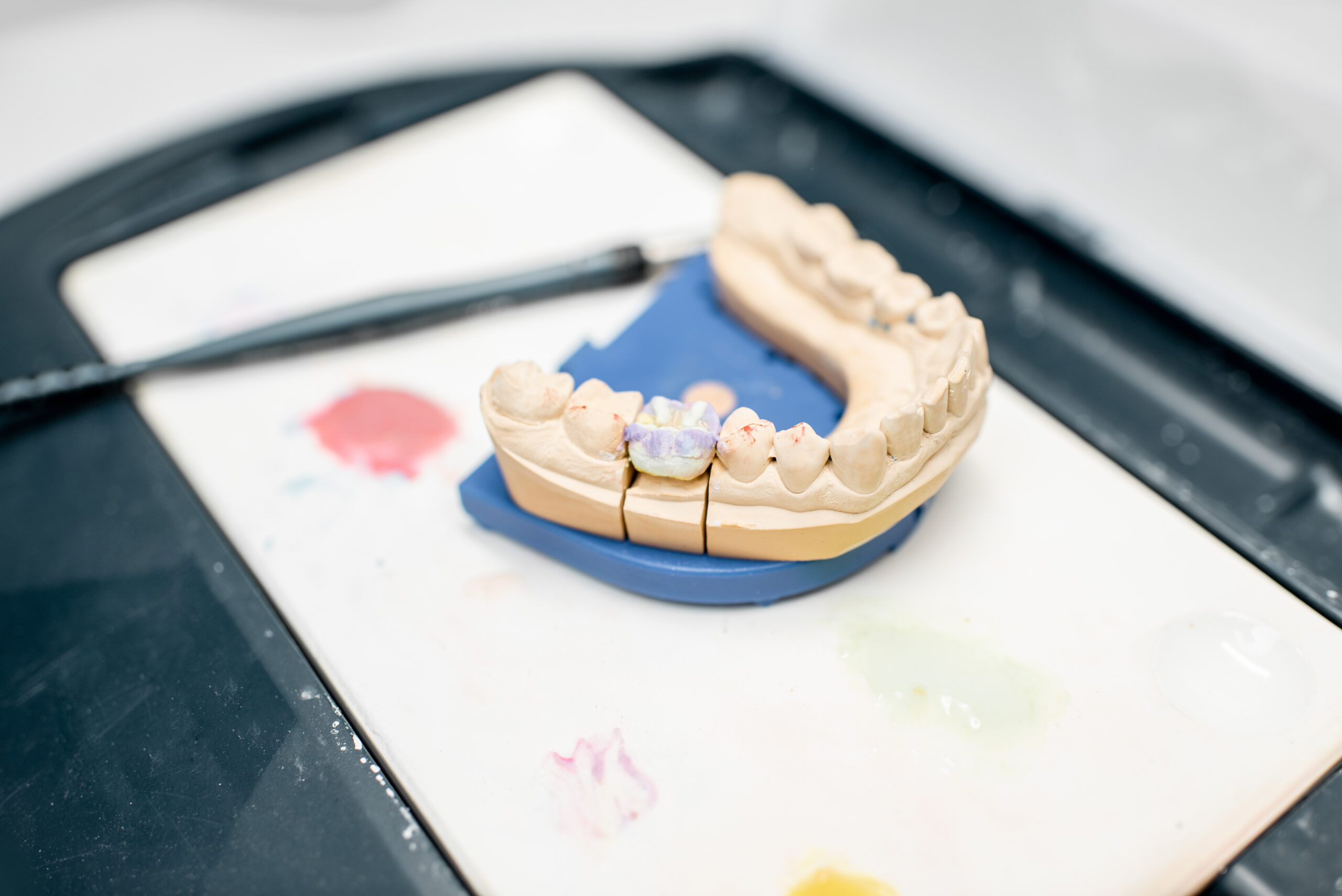 Dental crown prosthesis model in a lab showcasing crown restoration at Contemporary Prosthodontics in Duxbury