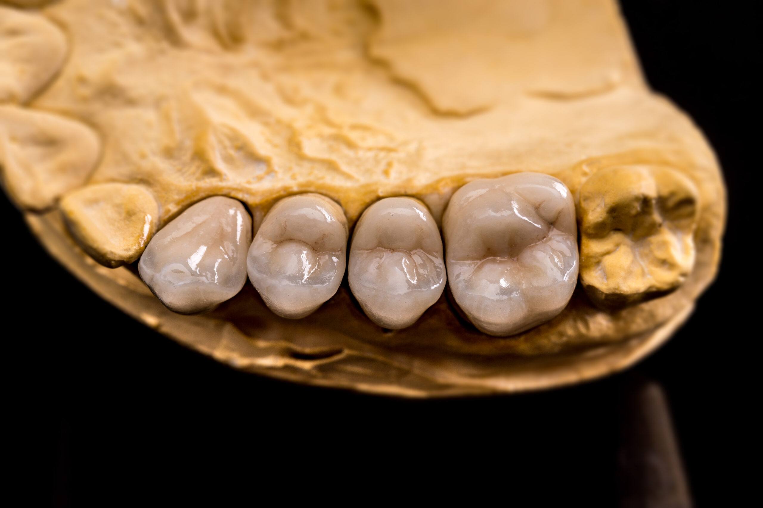 A dental mold showing four porcelain dental crowns in duxbury fitted on a plaster cast of the lower back teeth