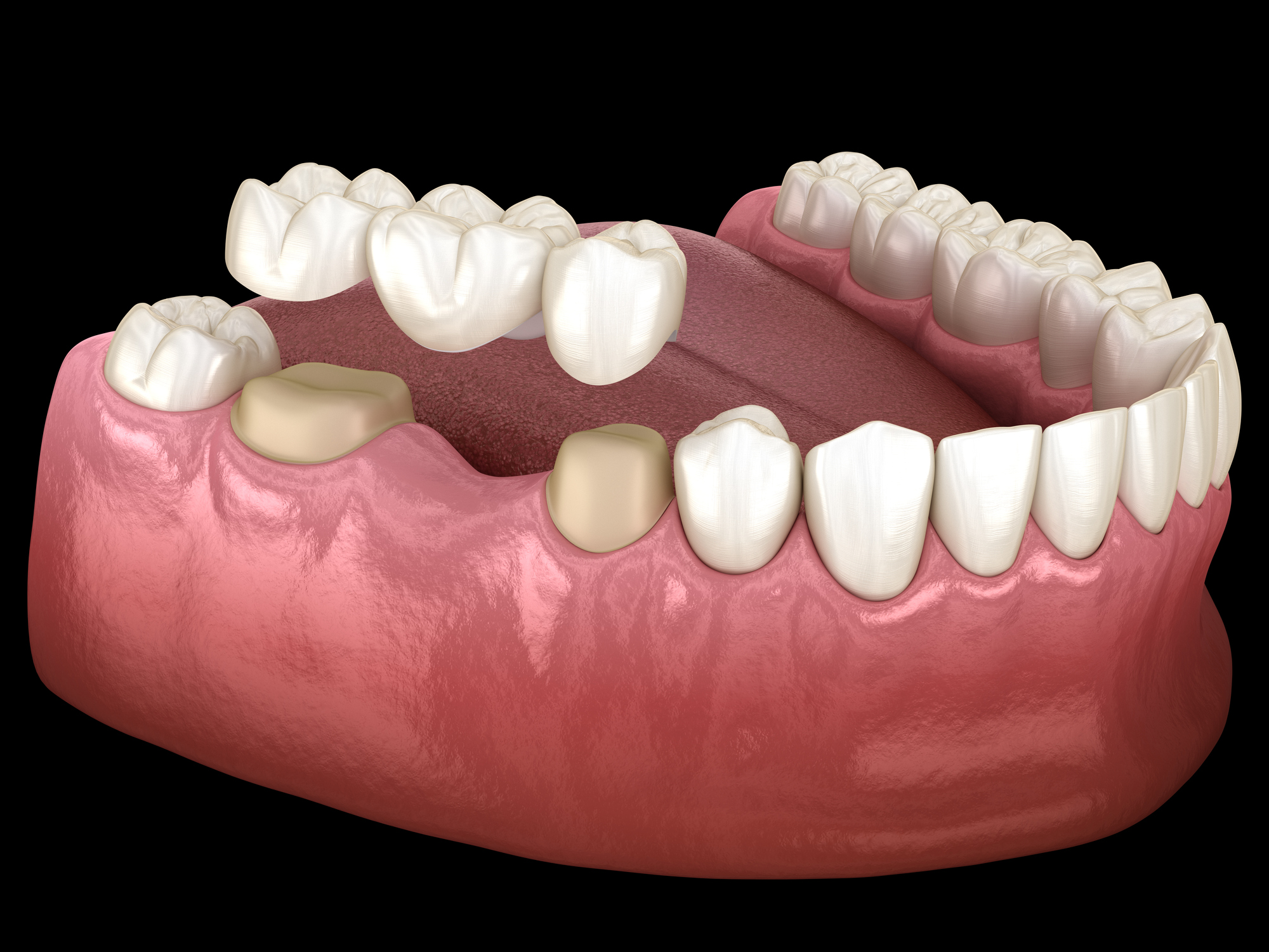 A 3D dental model showing dental bridges in duxbury being fitted over prepared abutment teeth on a lower jaw