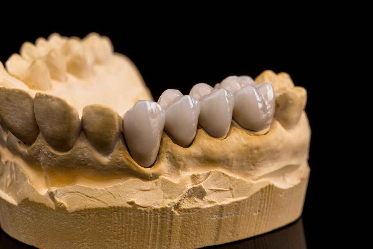 A dental stone model of a lower jaw showcasing a multi-unit porcelain dental bridge.